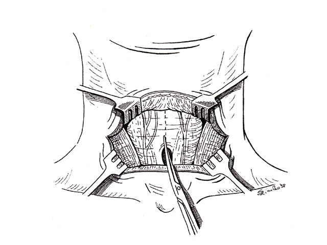 Tiroidectomia